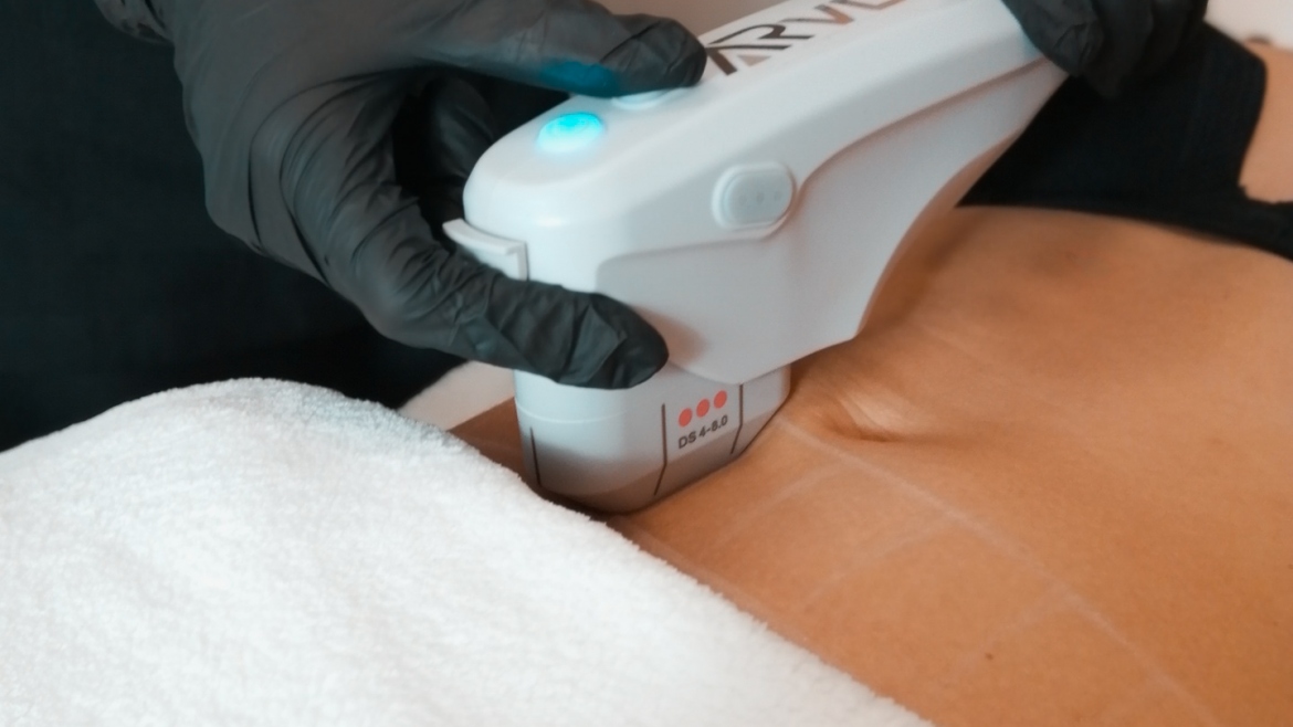 Εστιακός Υπέρηχος Λίπους HIFU